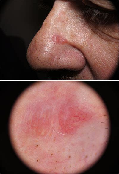 Pink nose lesion | MDedge