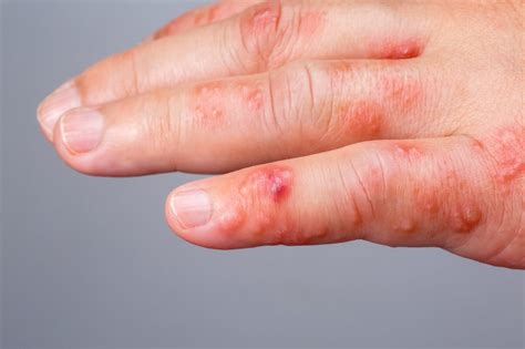 blisters