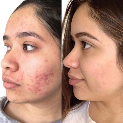 Azelan Gel Antes E Depois - Azelan: Antes e depois – Antes da Fama