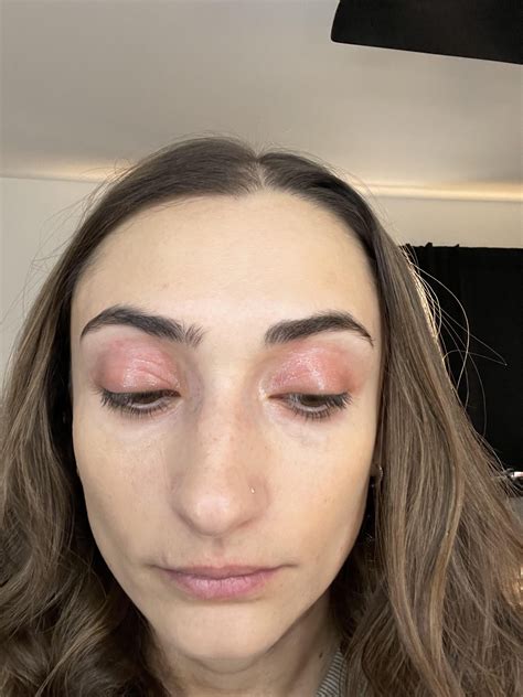 Eyelid Dermatitis Help : r/Autoimmune