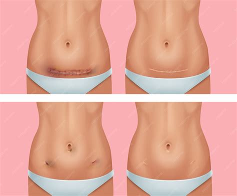 Premium Vector | Set of fresh and healed scars on body after abdomen wound