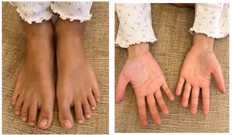 From Chilblains (Pernio) to Coeliac Disease—Should We Still Consider It