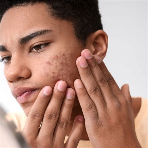 types  acne    treat  skinmart