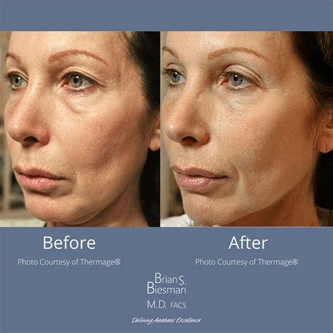 Thermage Noninvasive Skin Tightening | Nashville, TN