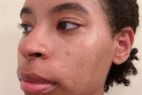 Unbelievable Blackhead Removal 2024: The Dermatologist's Approved Method - 7dqxst2