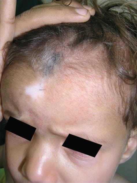 Piebaldism: A brief report and review of the literature. - Abstract ...