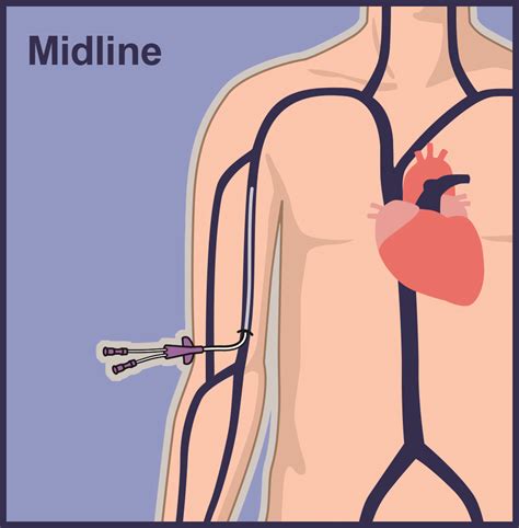 Peripheral IVs and PIVs | Vascular Wellness