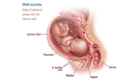 Placenta Accreta Pregnancy Complication - Brigham and Women's Hospital