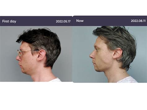 Mewing Before & After Results: 70+ Crazy Transformations
