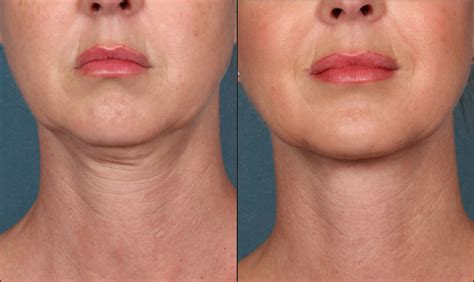 radio frequency rf skin tightening      alora skin