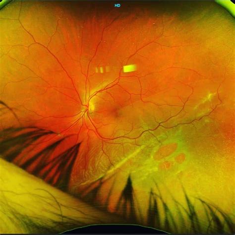 Rhegmatogenous Retinal Detachment - Outlook Eye Specialists