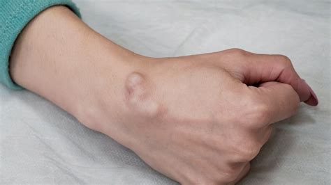 ganglion cysts symptoms   treatment