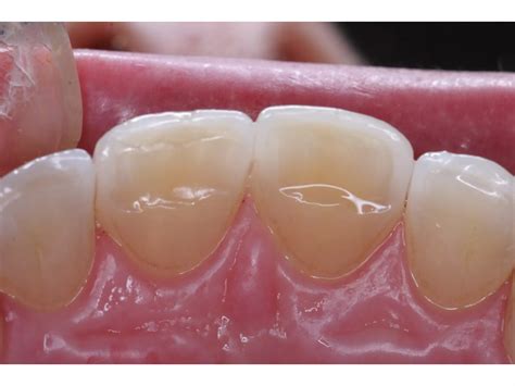 Functional and Esthetic Restoration of the Worn Dentition | PPT