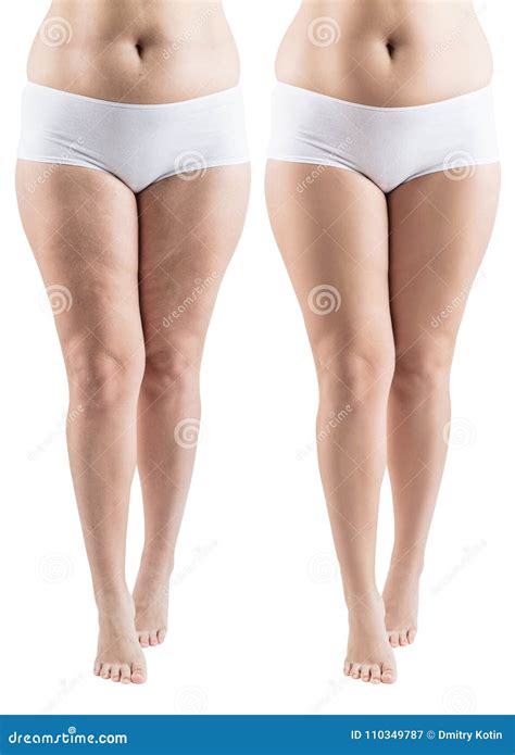 Woman Legs before and after Slimming. Stock Image - Image of dieting ...