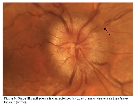 Papilledema Grades. EyeRounds.org - Ophthalmology - The University of Iowa