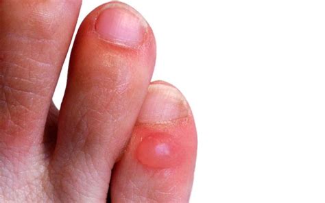 blister care  prevention survival daily