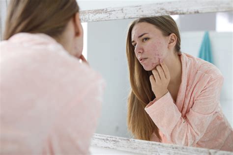 Acne: How A Dermatologist Can Help