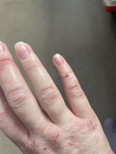 What helps you guys with psoriasis on hands? : r/Psoriasis
