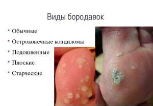 Брадавици, видове брадавици, симптоми и лечение на снимка
