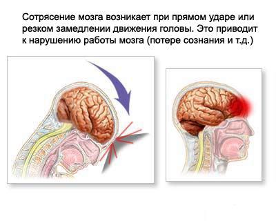 Сотрясение мозга: симптомы, лечение, признаки, последствия