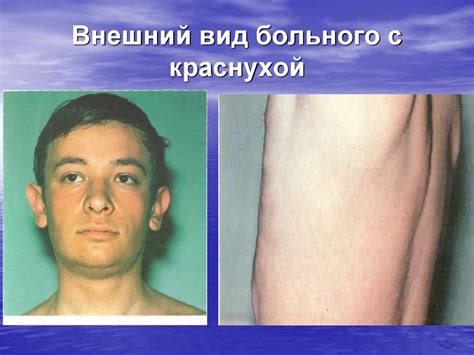 Корь. Скарлатина. Краснуха - презентация онлайн