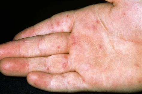 hand foot  mouth disease hfmd  comprehensive guide