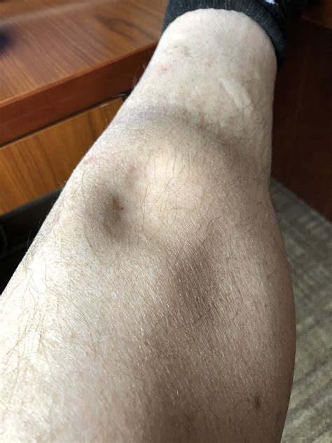Gordon's Notes: Why did the patient's leg swell up?