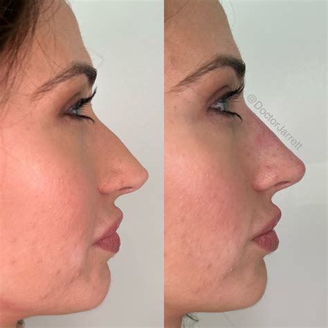 nonsurgical rhinoplasty designer aesthetics  dr jarrett schanzer