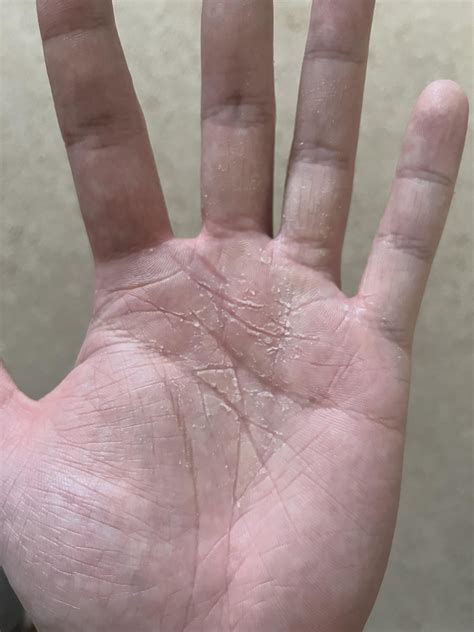 Flaky dead skin on the inside of my hands : r/SkincareAddictionUK