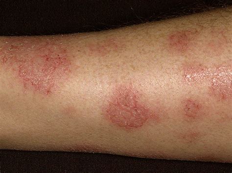 eczema nummular  alicia finch blog