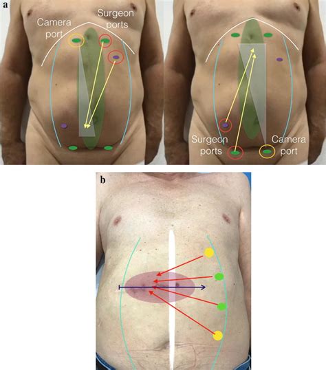 a Port placement, b port placement | Download Scientific Diagram