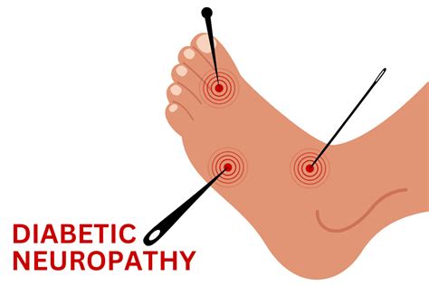 Understanding Diabetic Neuropathy – Ask The Nurse Expert