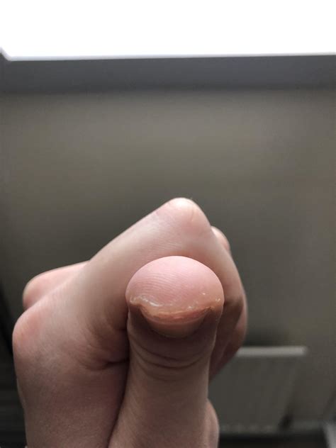 Lumpy skin texture after contraceptive implant insertion? : r