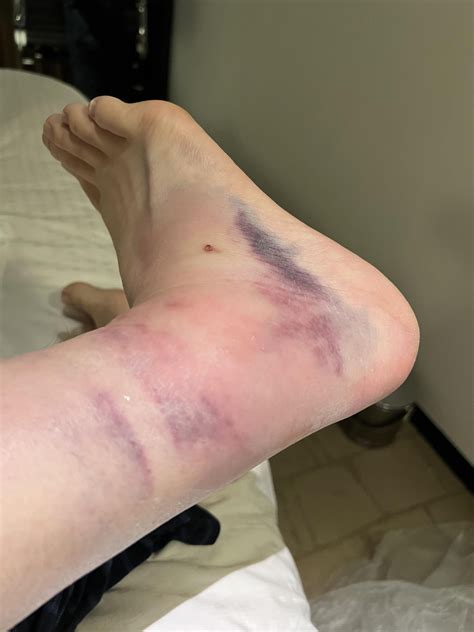 Does this look like a normal ankle sprain? : r/medical_advice