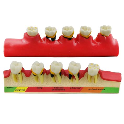 mua lab periodontal disease assort tooth typodont teeth model study