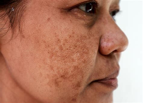 Melasma — Medical Secrets