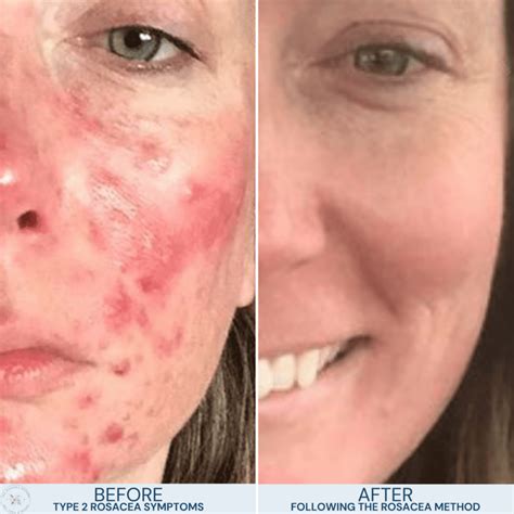 Natural Healing for Rosacea: Best Science-Backed Treatment & #1 Results ...