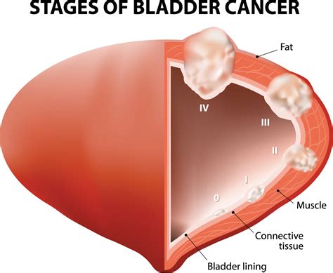 bladder cancer staging