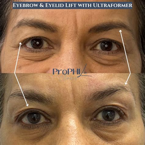 ultraformer iii treatment