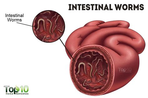 Human Intestinal Worms Symptoms Pictures Treatment