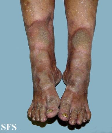 Progressive Palmoplantar Keratoderma - NC Commons