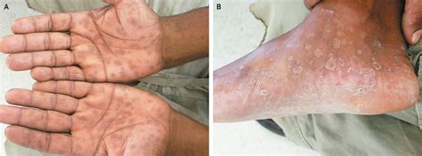 syphilis rash  feet