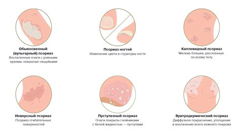 Есть такая болезнь — псориаз. Причины и симптомы псориаза. Рекомендации ...