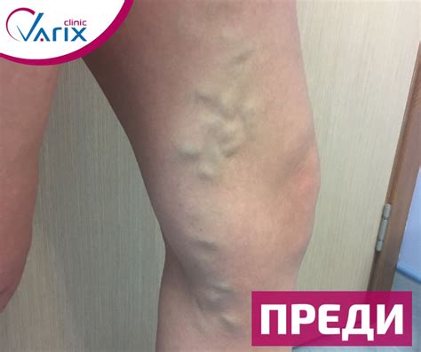 Ендовенозна лазерна аблация и склеротерапия с пяна и добавена реалност