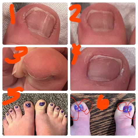 What do you think will be done? : r/Ingrown_Toenails