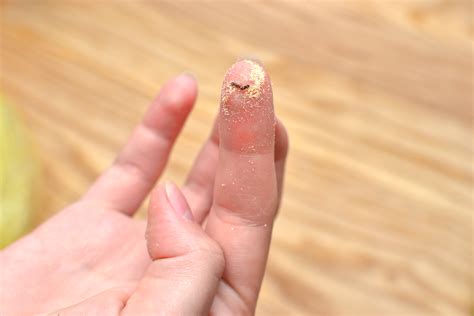 What Kills Grain Mites at Albina Giese blog