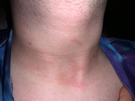 WHATS WRONG WITH THE SKIN ON MY COLLARBONE / NECK (info in comments : r