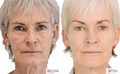 morpheus  treatment hertford jenny cader clinic