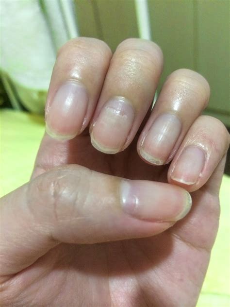 how to fix peeling fingernails