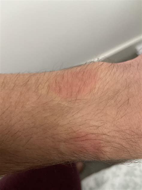 Itchy skin with no rash after COVID? : r/covidlonghaulers